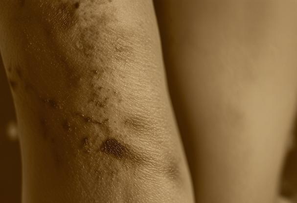 Photographie en teinte sépia montrant le contraste marqué d'une peau affectée par une brûlure au second degré, évoquant douleur et guérison en monochrome.